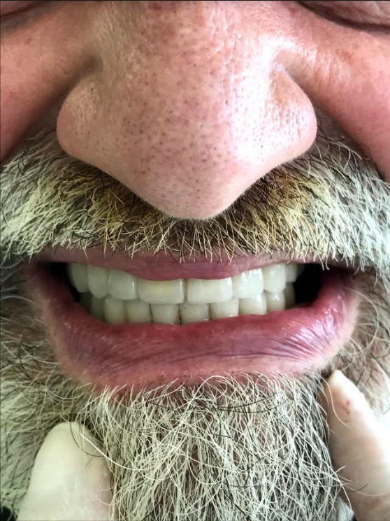 εμφυτεύματα δοντιών 2 μετά